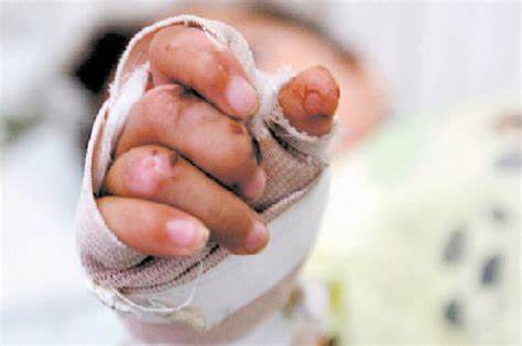 Noticias Antioquia: Este año van menos casos de quemados por pólvora